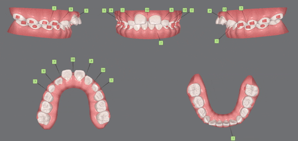 인비절라인 제작과정, 제작까지 소요시간, 어떻게 만들어지는지 궁금하다면?  (치아교정 l 투명교정 l 인비절라인) 관련 이미지 9