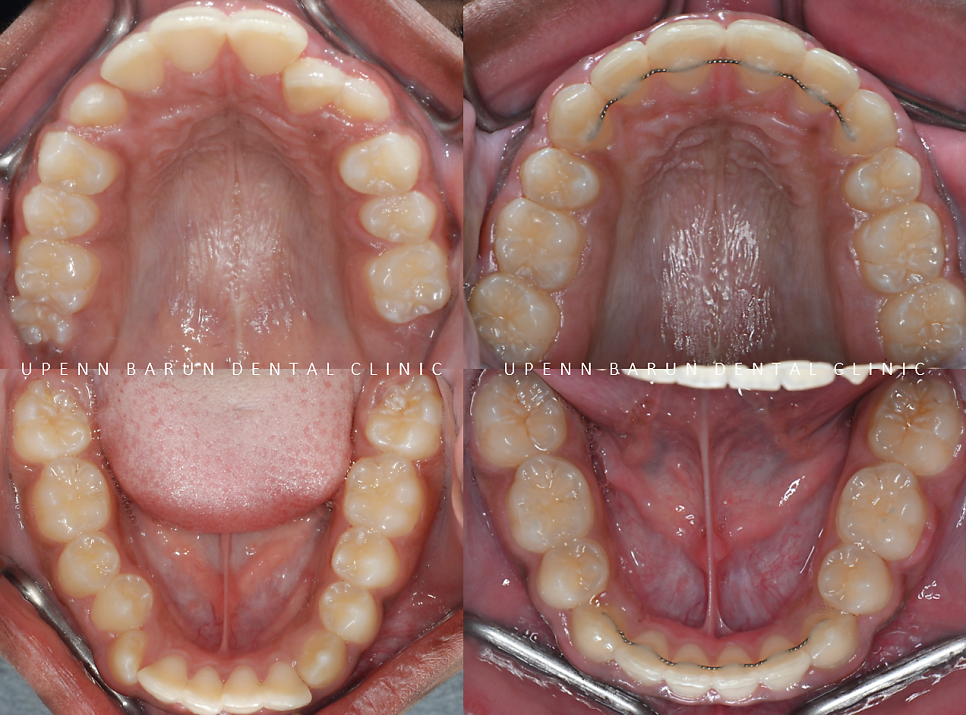 성장기에 돌출입이 고민이라면? 돌출입청소년교정 입술무력증 해결도 유펜바른치과에서! (잠실청소년교정 잠실돌출입교정 돌출입교정기간 발치교정외모변화 외국인교정치과) 관련 이미지 11