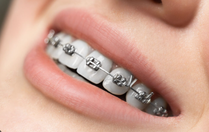 EXPLORING YOUR OPTIONS: DAMON BRACES, CERAMIC BRACES, AND METAL BRACES FOR ORTHODONTIC TREATMENT 관련 이미지 3