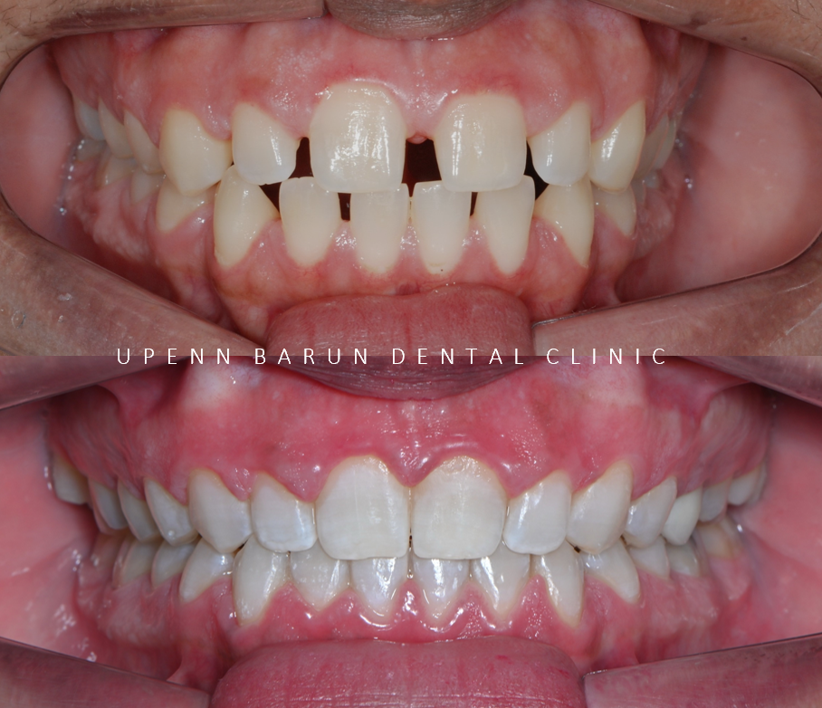 인비절라인높은등급 인비절라인플래티넘엘리트 잠실교정치과 잠실인비절라인 (잠실교정치과 송파인비절라인 인비절라인전후사진 인비절라인후기) 관련 이미지 6