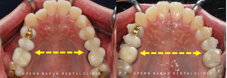 ABO 미국 치과교정과 전문의의 비수술치아교정 악궁확장장치 후기 (잠실교정전후 잠실새내교정치과 잠실교정치과 교정통증  앞니 변화) 관련 이미지 5