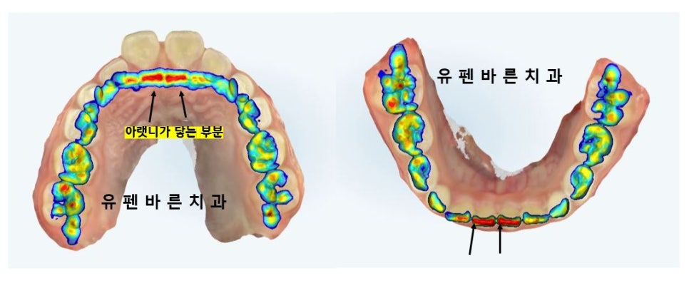 저도 친구들이 많이 하는 인비절라인교정 하고싶어요! 관련 이미지 4