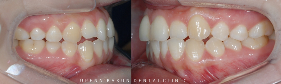 안면비대칭, 잠실수술교정, 잠실양악수술도 유펜바른치과입니다. 관련 이미지 6