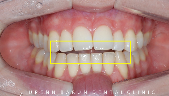개방교합은 교정용 미니스크류 쓰지말고 인비절라인만으로 쉽게 해결하세요! (잠실인비절라인  잠실새내인비절라인  개방교합교정  잠실새내교정치과) 관련 이미지 4