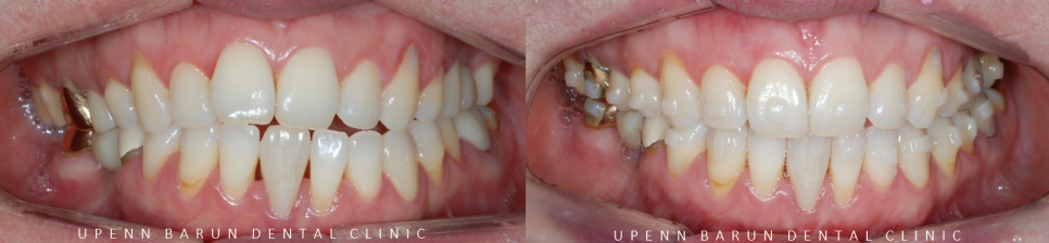 인비절라인 공식 스피커가 상주하고 치료하는 송파교정잘하는치과 유펜바른치과 (잠실성인교정 잠실재교정 잠실인비절라인 성인인비절라인교정 잠실나루역교정치과 문정동교정치과 삼전역교정치과) 관련 이미지 8