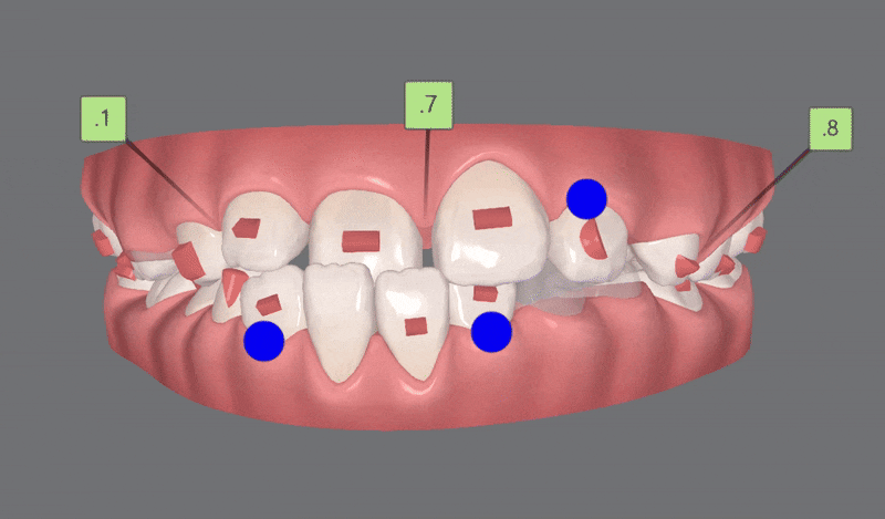 다이아몬드등급치과에서 인비절라인퍼스트로 반대교합 해결! 1차, 2차교정을 한번에!( 어린이반대교합 송파인비절라인퍼스트 잠실엘스상가교정치과 잠실인비절라인퍼스트 인비절라인스피커치과) 관련 이미지 10