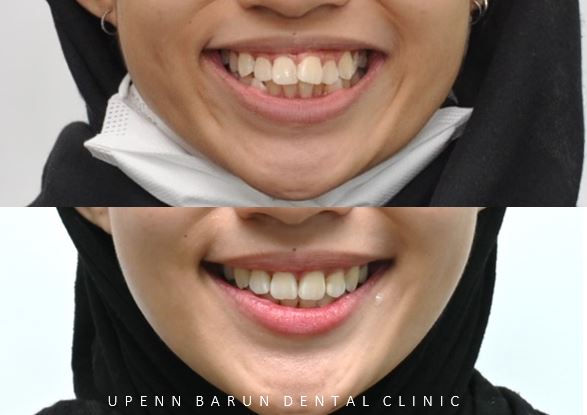 잠실돌출입교정 잠실발치교정 후기가 궁금하다면? (교정후얼굴변화후기 잠실교정치과 돌출입교정후기 돌출입전후사진) 관련 이미지 4