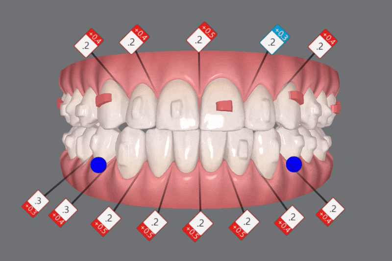 "치아가 앞으로 뻐드러졌어요!" 송파인비절라인다이아몬드등급치과에서!!(비발치인비절라인 뻐드렁니교정치과 돌출입교정치과) 관련 이미지 11