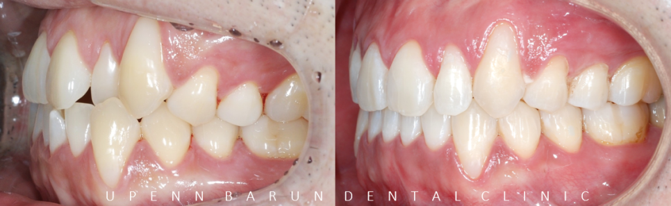 잠실덧니교정 인비절라인으로 컴플렉스 해결! (비발치교정 인비절라인등급 인비절라인후기 ) 관련 이미지 11