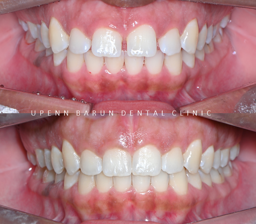 잠실인비절라인등급 잠실부분교정 앞니틈교정 인비절라인라이트 옵션으로 빠르게 해결한 후기 (삼성역부분교정 인비절라인앞니재교정 잠실역교정치과 삼전동인비절라인 삼전동교정치과) 관련 이미지 5