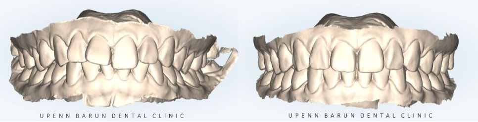 앞니부분교정 인비절라인라이트로 해결하기 (잠실인비절라인치과 송파인비절라인치과 잠실새내인비절라인치과 강동인비절라인치과 헬리오시티인비절라인 송파역인비절라인 석촌역인비절라인) 관련 이미지 3