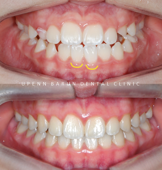 송파인비절라인다이아몬드등급치과 에서 인비절라인으로 1차 2차 교정을 한번에! (송파인비절라인퍼스트 잠실어린이인비절라인 인비절라인소아교정 잠실소아교정 어린이반대교합) 관련 이미지 5