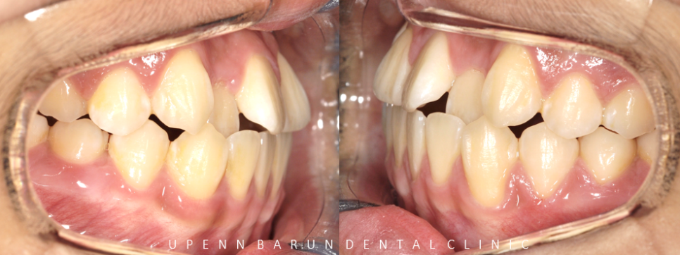 비발치교정 성장기교정 청소년치아교정은 잠실교정치과 유펜바른치과에서 관련 이미지 5