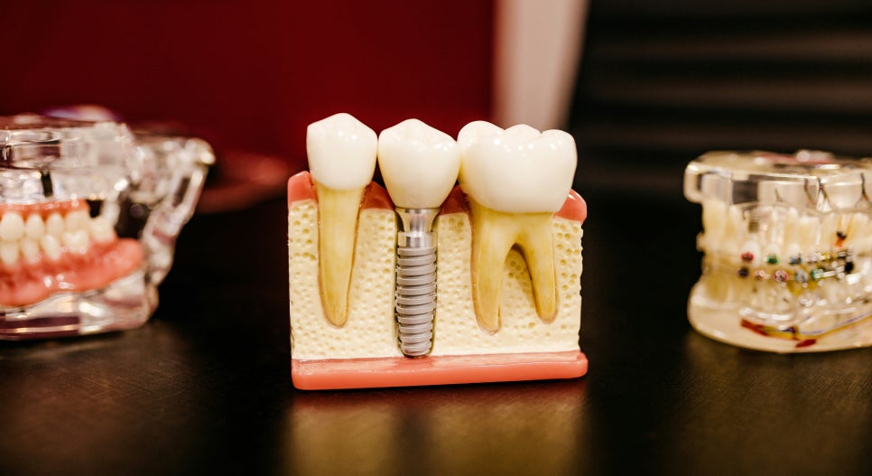 Advantages of Implant Treatment in our dental hospital located in Jamsil-dong, Seoul 관련 이미지 1