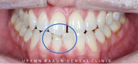 ABO 미국 치과교정과 전문의의 비수술치아교정 악궁확장장치 후기 (잠실교정전후 잠실새내교정치과 잠실교정치과 교정통증  앞니 변화) 관련 이미지 7