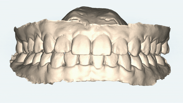 주걱턱교정, 수술교정, 양악수술도 잠실교정치과 유펜바른치과에서 관련 이미지 12