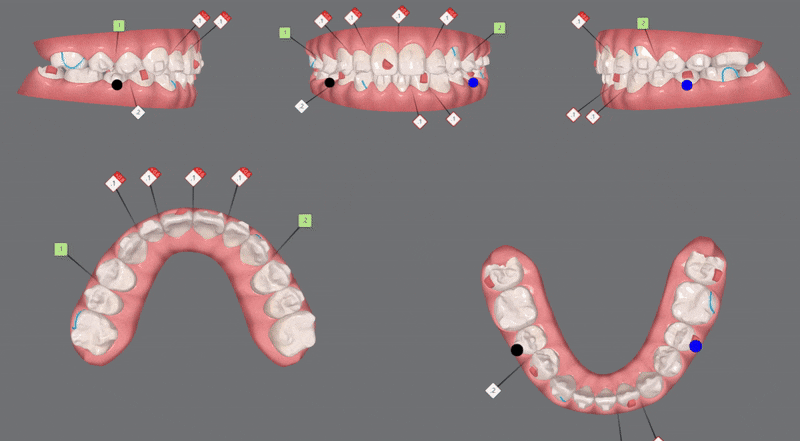 2024년 송파구 단일 치과의원급 중 유일!!! 인비절라인다이아몬드등급 달성한 유펜바른치과의 청소년인비절라인 후기 (청소년반대교합 어린이반대교합 잠실인비절라인잘하는치과) 관련 이미지 16