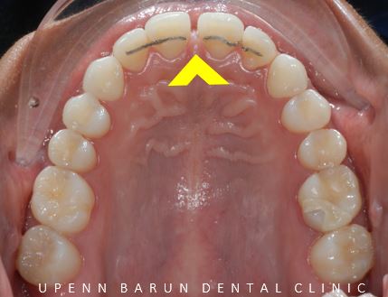 앞니벌어짐 인비절라인익스프레스로 해결하기 (인비절라인앞니부분교정 인비절라인재교정 송파인비절라인 잠실인비절라인 잠실교정치과 인비절라인익스프레스비용) 관련 이미지 5