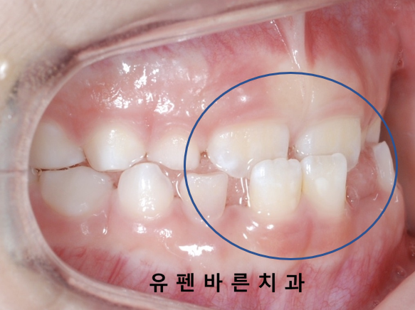 아이가 반대교합(주걱턱)인데 1차교정을 꼭해야 하나요? 관련 이미지 3