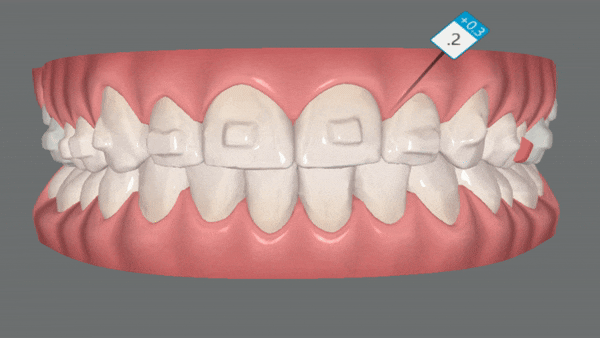 잠실교정치과 유펜바른치과의 인비절라인익스프레스가 특별한 이유 (5개월 인비절라인급속교정 잠실인비절라인 송파인비절라인 인비절라앞니부분교정) 관련 이미지 11