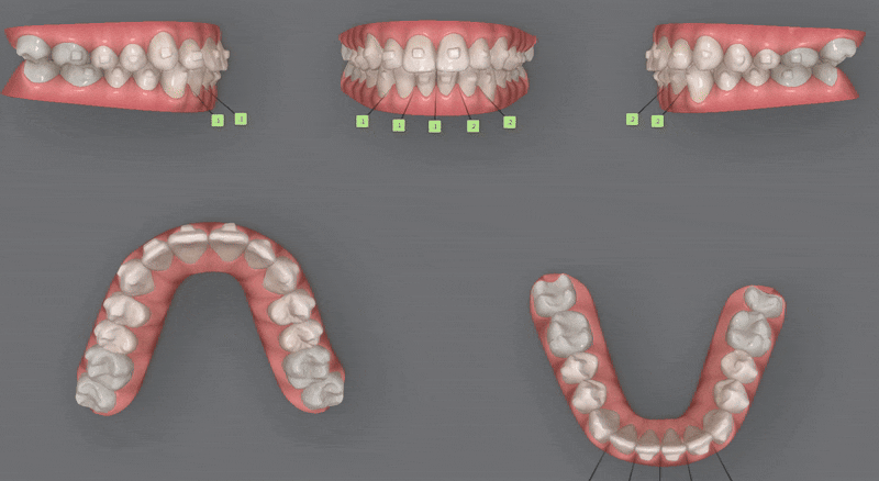 가지런했던 앞니가 삐뚤빼뚤해졌어요! 잠실다이아몬드등급 잠실인비절라인 인비절라인익스프레스 앞니 삐뚤어짐 해결(앞니급속교정 앞니투명교정 인비절라인급속교정 인비절라인전후사진) 관련 이미지 10