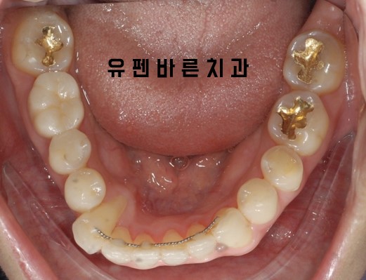 앞니부분교정 잠실인비절라인 라이트 옵션 들어보셨나요? 관련 이미지 5