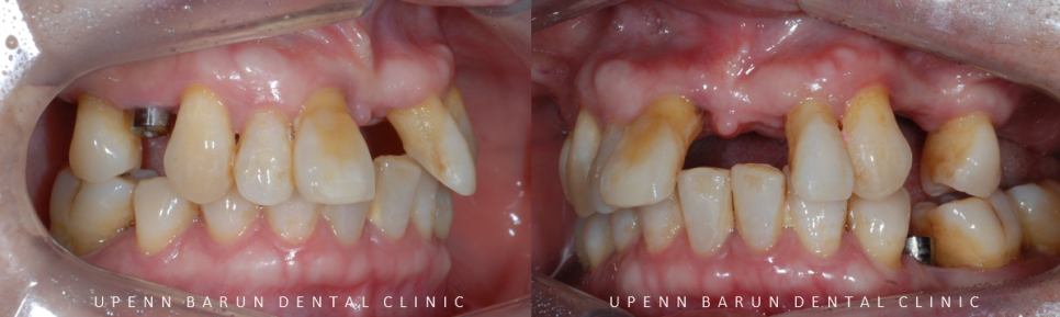 잠실새내역임플란트 잠실새내역치과 유펜바른치과에서 전체임플란트치료 ( 잠실임플란트후기 임플란트기간  전체임플란트) 관련 이미지 7