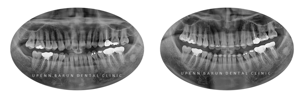 주걱턱 반대교합도 잠실인비절라인 잠실교정치과 유펜바른치과에서!(비발치주걱턱교정 잠실성인교정 반대교합인비절라인 잠실교정치과 주걱턱교정후기) 관련 이미지 6