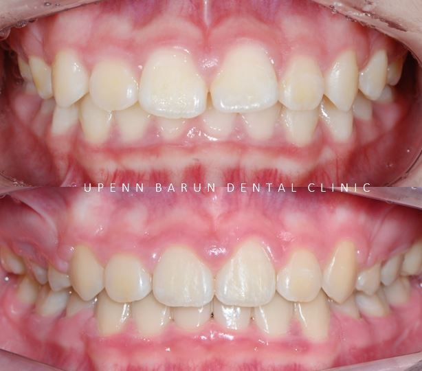 잠실새내역청소년교정 잠실돌출입발치교정은 유펜바른치과!(잠실중학생발치교정 잠실무턱교정 잠실새내소아교정치과 잠실새내교정잘하는치과 발치교정외모변화) 관련 이미지 9