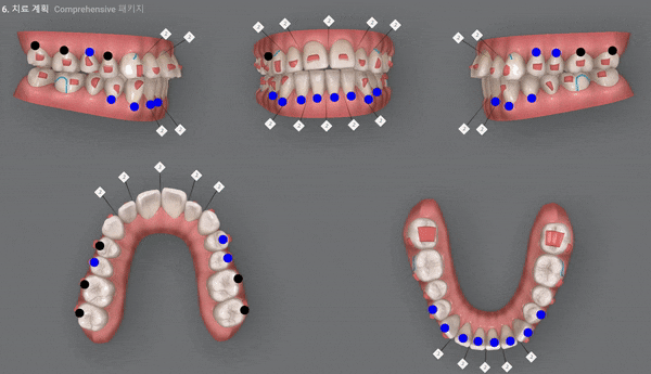 개방교합은 교정용 미니스크류 쓰지말고 인비절라인만으로 쉽게 해결하세요! (잠실인비절라인  잠실새내인비절라인  개방교합교정  잠실새내교정치과) 관련 이미지 10