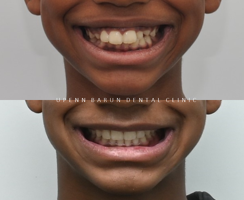 성장기에 돌출입이 고민이라면? 돌출입청소년교정 입술무력증 해결도 유펜바른치과에서! (잠실청소년교정 잠실돌출입교정 돌출입교정기간 발치교정외모변화 외국인교정치과) 관련 이미지 13