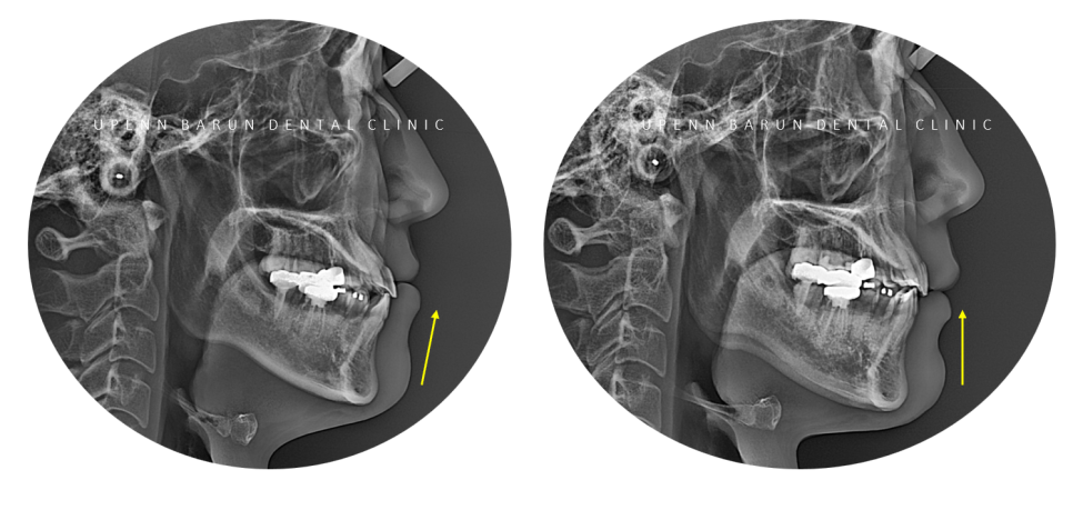 주걱턱 반대교합도 잠실인비절라인 잠실교정치과 유펜바른치과에서!(비발치주걱턱교정 잠실성인교정 반대교합인비절라인 잠실교정치과 주걱턱교정후기) 관련 이미지 7