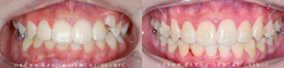 잠실소아인비절라인 잠실어린이인비절라인 송파인비절라인 잠실인비절라인후기 (잠실새내교정치과 엘스상가교정치과 파인애플상가교정치과 잠실새내역인비절라인 청소년교정후기 잠실인비절라인퍼스트) 관련 이미지 15