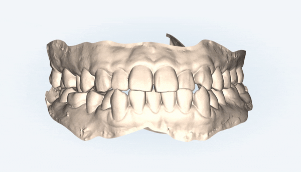 주걱턱 반대교합도 잠실인비절라인 잠실교정치과 유펜바른치과에서!(비발치주걱턱교정 잠실성인교정 반대교합인비절라인 잠실교정치과 주걱턱교정후기) 관련 이미지 22