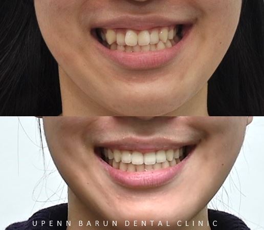 유학생치아교정 유학생교정치과 잠실교정치과 잠실데이몬교정 데이몬클리어교정 Wide Smile (송파교정치과 잠실새내교정치과 강동교정치과 헬리오시티교정치과 예쁜미소 Smile Arc) 관련 이미지 4