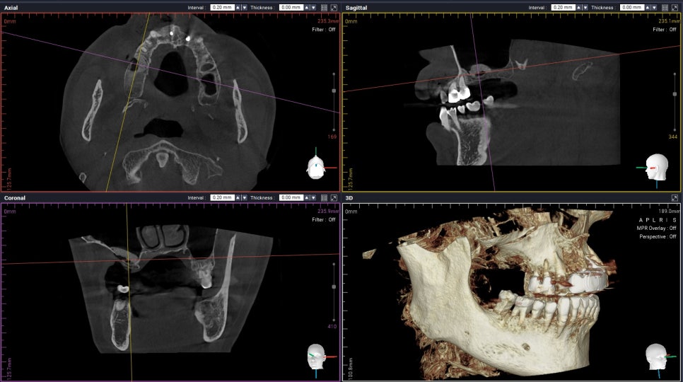 상악동 때문에 대학병원가서 임플란트 하라고 권유받으신 분들 필독!!! 관련 이미지 3