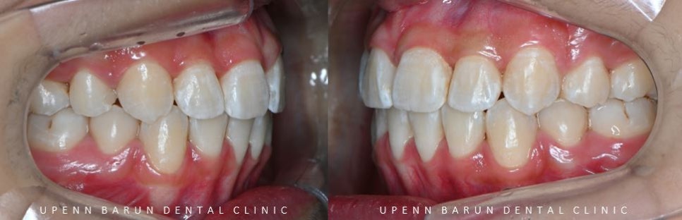 잠실돌출입교정 잠실발치교정 후기가 궁금하다면? (교정후얼굴변화후기 잠실교정치과 돌출입교정후기 돌출입전후사진) 관련 이미지 10