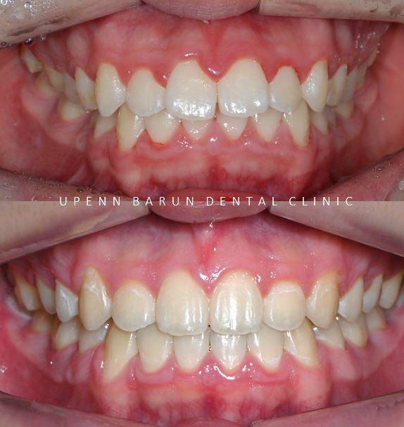 잠실청소년교정 청소년소년돌출입교정 잠실발치교정은 유펜바른치과에서! (잠실나루역교정치과 삼전역교정치과 잠실새내교정치과 돌출입전후 발치교정전후사진) 관련 이미지 11