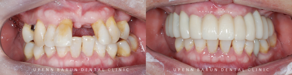 잠실새내역임플란트 잠실새내역치과 유펜바른치과에서 전체임플란트치료 ( 잠실임플란트후기 임플란트기간  전체임플란트) 관련 이미지 3