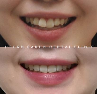 앞니부분교정 인비절라인라이트로 해결하기 (잠실인비절라인치과 송파인비절라인치과 잠실새내인비절라인치과 강동인비절라인치과 헬리오시티인비절라인 송파역인비절라인 석촌역인비절라인) 관련 이미지 4