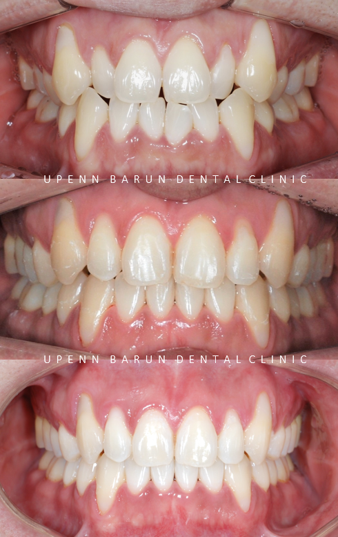 잠실덧니교정 인비절라인으로 컴플렉스 해결! (비발치교정 인비절라인등급 인비절라인후기 ) 관련 이미지 14