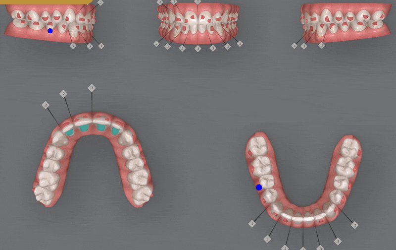 인비절라인다이아몬드등급치과에서 28개의 교정장치로 고민 해결한 후기가 궁금하다면? (잠실송곳니덧니교정 잠실인비절라인 인비절라인교정기간 투명교정장치후기 잠실인비절라인후기) 관련 이미지 6