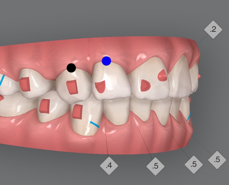 해외거주 중인데 발치교정도 인비절라인으로 가능한가요? 관련 이미지 5