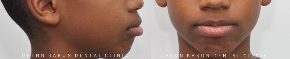 성장기에 돌출입이 고민이라면? 돌출입청소년교정 입술무력증 해결도 유펜바른치과에서! (잠실청소년교정 잠실돌출입교정 돌출입교정기간 발치교정외모변화 외국인교정치과) 관련 이미지 4