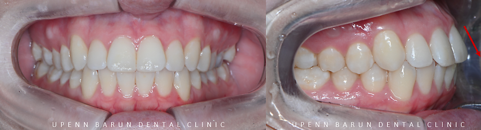 가지런했던 앞니가 삐뚤빼뚤해졌어요! 잠실다이아몬드등급 잠실인비절라인 인비절라인익스프레스 앞니 삐뚤어짐 해결(앞니급속교정 앞니투명교정 인비절라인급속교정 인비절라인전후사진) 관련 이미지 4