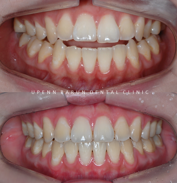 반대교합+개방교합 비수술교정 유펜바른치과에서 재교정한 후기! ( 비발치개방교합 비발치반대교합 재교정후기 잠실교정치과 미니스크류비수술교정 악궁확장장치 MARPE) 관련 이미지 6