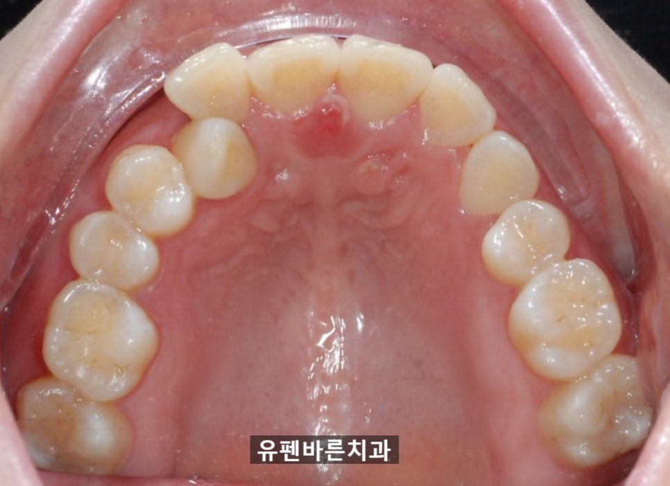 해외거주 중인데 발치교정도 인비절라인으로 가능한가요? 관련 이미지 7