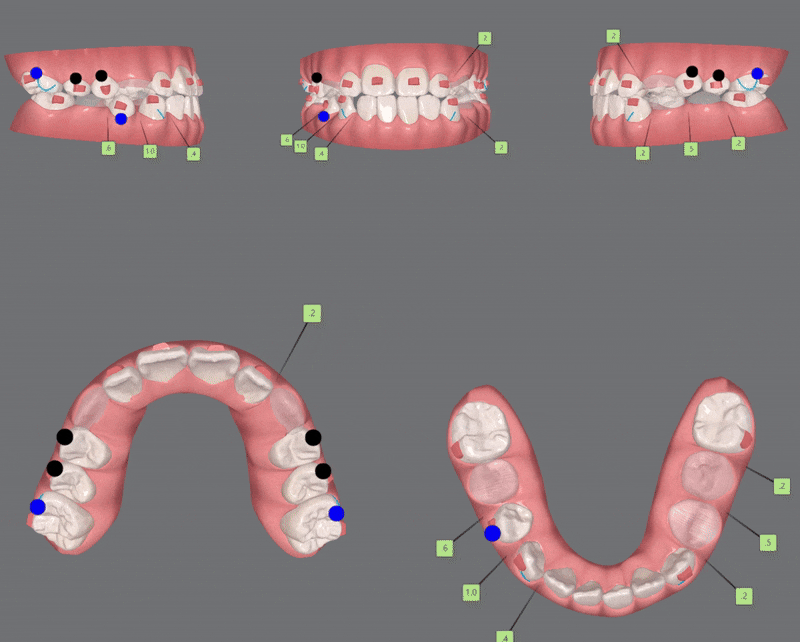 송파인비절라인다이아몬드등급치과 에서 인비절라인으로 1차 2차 교정을 한번에! (송파인비절라인퍼스트 잠실어린이인비절라인 인비절라인소아교정 잠실소아교정 어린이반대교합) 관련 이미지 11