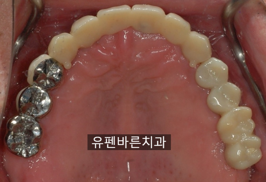 해보니까 임플란트가 편해요!!! 관련 이미지 4