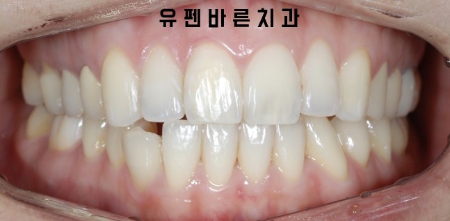 앞니부분교정 잠실인비절라인 라이트 옵션 들어보셨나요? 관련 이미지 7